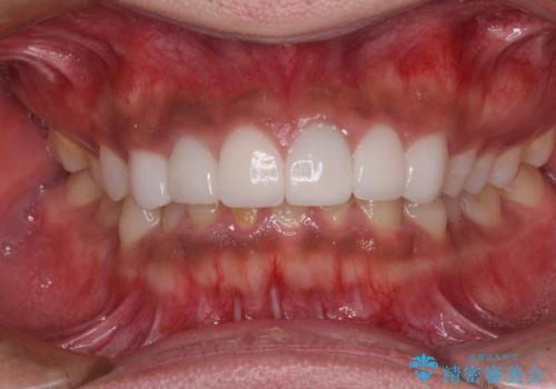 欠けてしまった前歯のセラミック　同じ色合いで再製作の治療後
