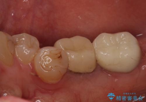 痛みを感じる奥歯　根管治療とインプラント治療の治療後