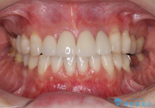 矯正しても虫歯が気になる　前歯のオールセラミッククラウンの治療後
