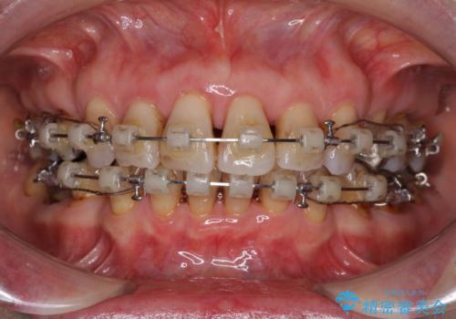 閉じにくい口元を改善したい　ワイヤー装置での抜歯矯正の治療中