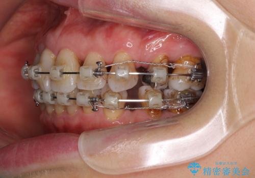 閉じにくい口元を改善したい　ワイヤー装置での抜歯矯正の治療中