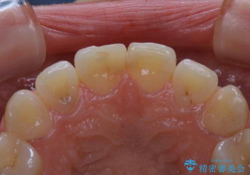 何度も欠けてしまう前歯を被せ物で治療の治療前