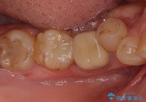 痛みを感じる奥歯　根管治療とインプラント治療の治療前