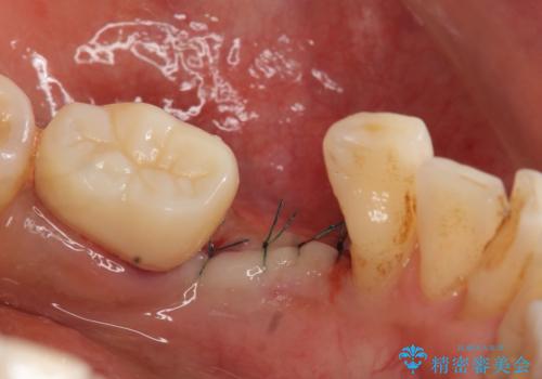 インプラント　左下奥歯の咬み合わせの改善の治療後