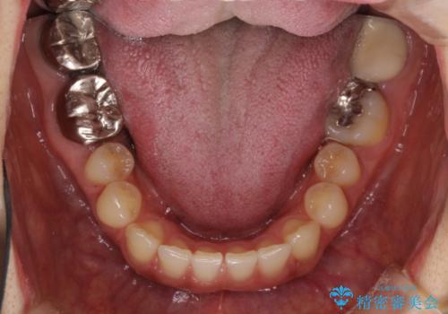 隙間だらけの歯列をきれいに　インビザライン矯正とセラミック補綴治療の治療中