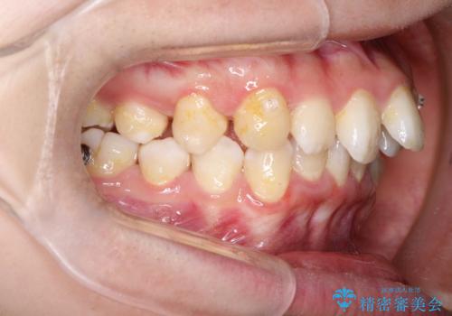 重度のガタガタのインビザラインによる非抜歯矯正の治療中