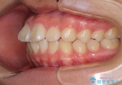 前歯のデコボコを短期間で治療　目立たないワイヤー矯正の治療前