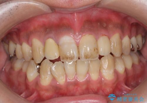 PMTC(歯科医院での専門的クリーニング)でステインを除去し白くきれいな歯に!の治療前