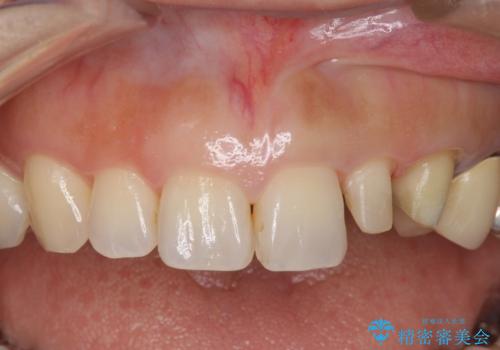 前歯が左右対称じゃない　保険の被せ物をきれいにしたい　ホワイトニング併用の治療中