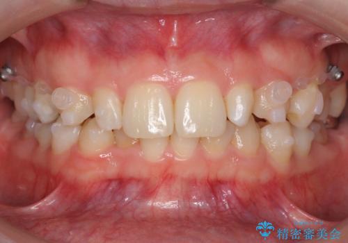 前歯を整えたい　小さい前歯がある　矯正・セラミック併用で美しく　インビザラインでも抜歯矯正できますの治療中
