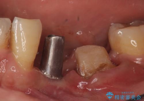 インプラント　左下奥歯の咬み合わせの改善の治療中