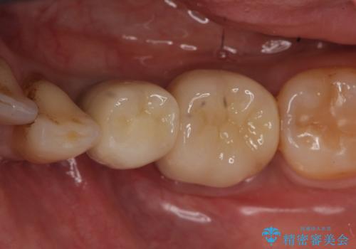 インプラント　左下奥歯の咬み合わせの改善の治療後