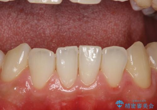 歯科検診と歯のお掃除の治療後
