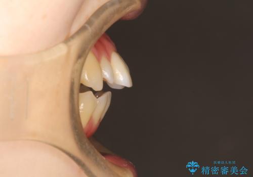 ワイヤーによる出っ歯の矯正　前歯でかめるようにの治療前