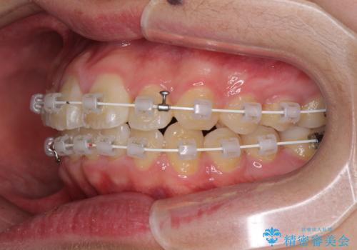 前歯のデコボコを短期間で治療　目立たないワイヤー矯正の治療中