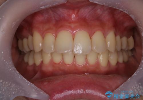 歯科衛生士による専門的なクリーニング　PMTCの治療後