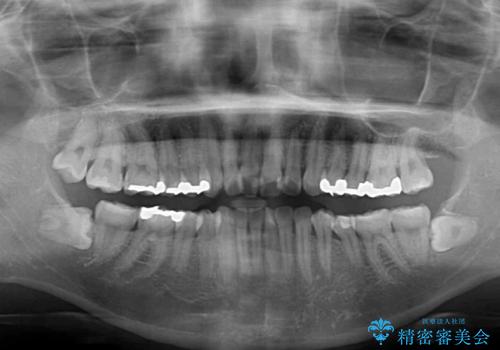 前歯の突出を軽減　インビザラインによる抜歯矯正の治療前