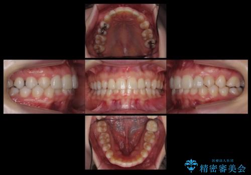 前歯を整えたい　小さい前歯がある　矯正・セラミック併用で美しく　インビザラインでも抜歯矯正できますの治療後