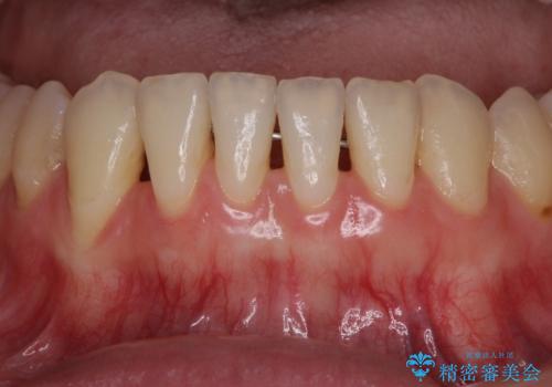 下顎前歯の歯肉退縮　歯肉移植による根面被覆の症例 治療前