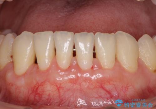 下顎前歯の歯肉退縮　歯肉移植による根面被覆の症例 治療後