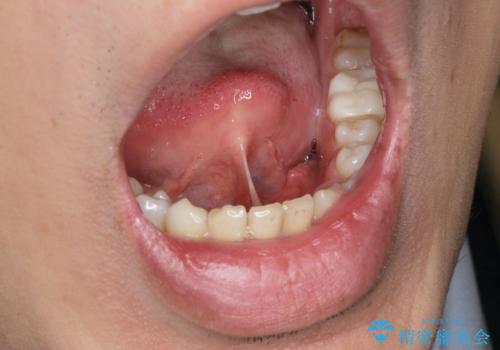 [舌小帯形成術]  滑舌が悪いと言われるの症例 治療前