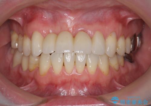 前歯が折れた　前歯部審美セラミックブリッジ治療の治療後
