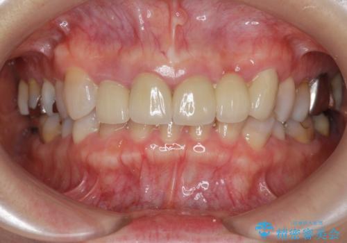 [歯ぐきの腫れを改善]  不適合なセラミッククラウンの治療前