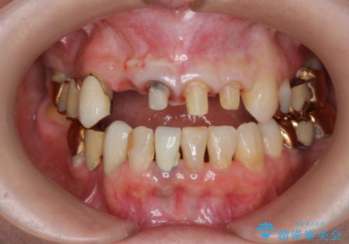 状況に応じた前歯の補綴計画の治療中