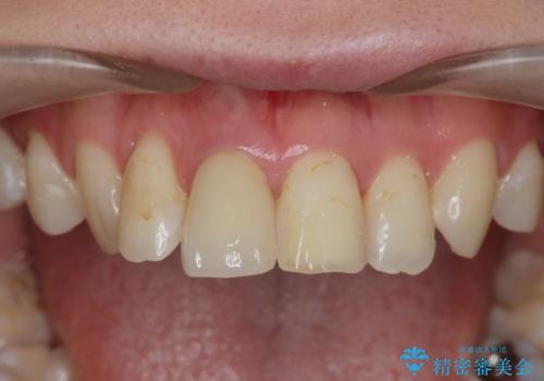 [前歯の変色] 前歯の見た目を改善したいの治療後