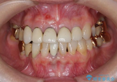 状況に応じた前歯の補綴計画の治療前