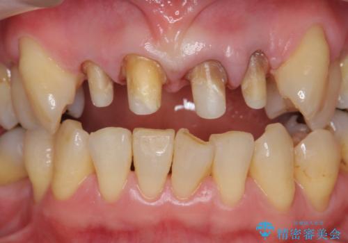 [前歯のグラつき]　根本的な前歯の審美治療を希望の治療中