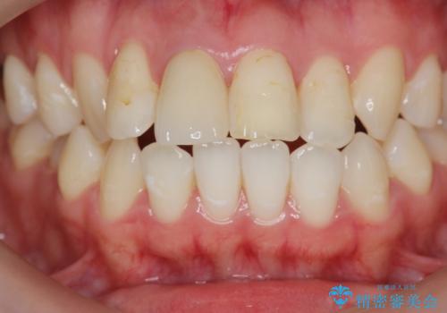 [前歯の変色] 前歯の見た目を改善したいの治療後