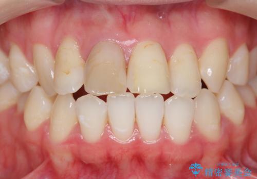 [前歯の変色] 前歯の見た目を改善したいの治療前