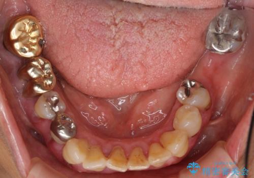 歯ぐきから血が出る、歯ぐきが腫れている　80代女性の治療前