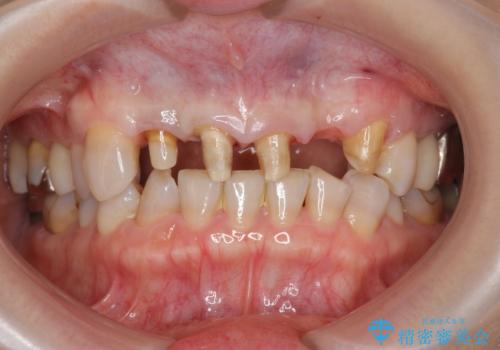 [歯ぐきの腫れを改善]  不適合なセラミッククラウンの治療中