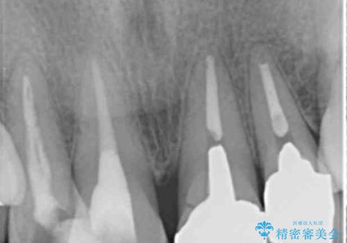 [前歯のグラつき]　根本的な前歯の審美治療を希望の治療前