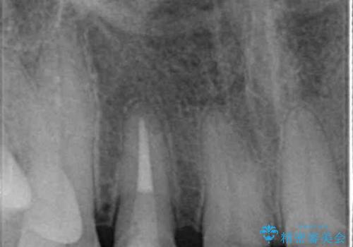 [歯ぐきの腫れを改善]  不適合なセラミッククラウンの治療中