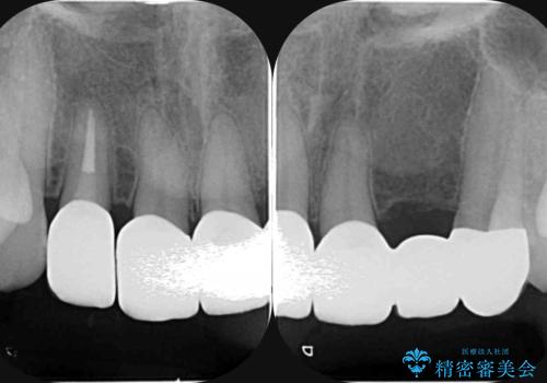 [歯ぐきの腫れを改善]  不適合なセラミッククラウンの治療後
