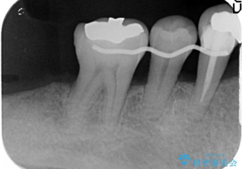 骨を再生させて歯周病を治す　再生療法　50代男性の治療中