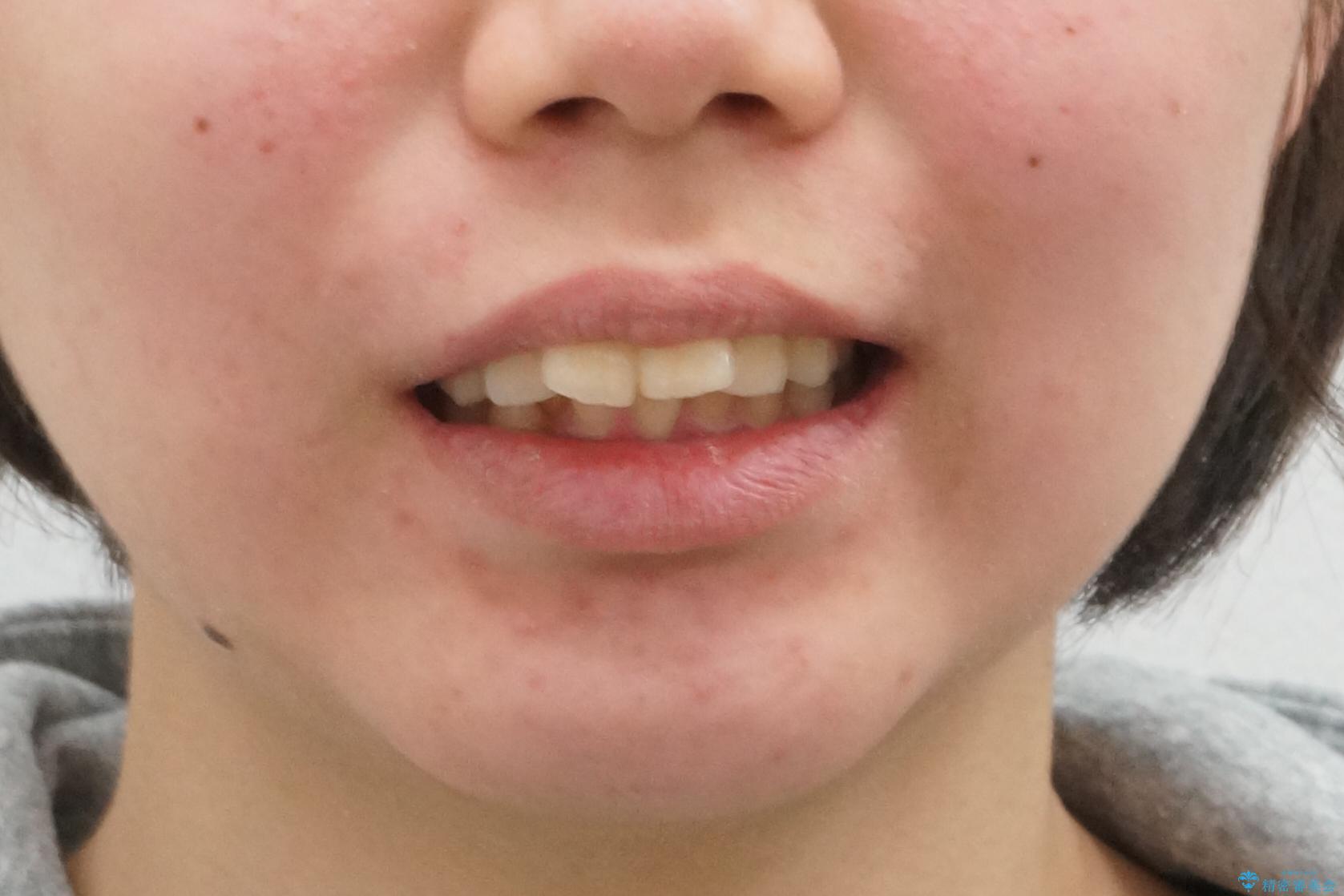 20代女性　出っ歯　口元を引っ込めたいの治療前（顔貌）