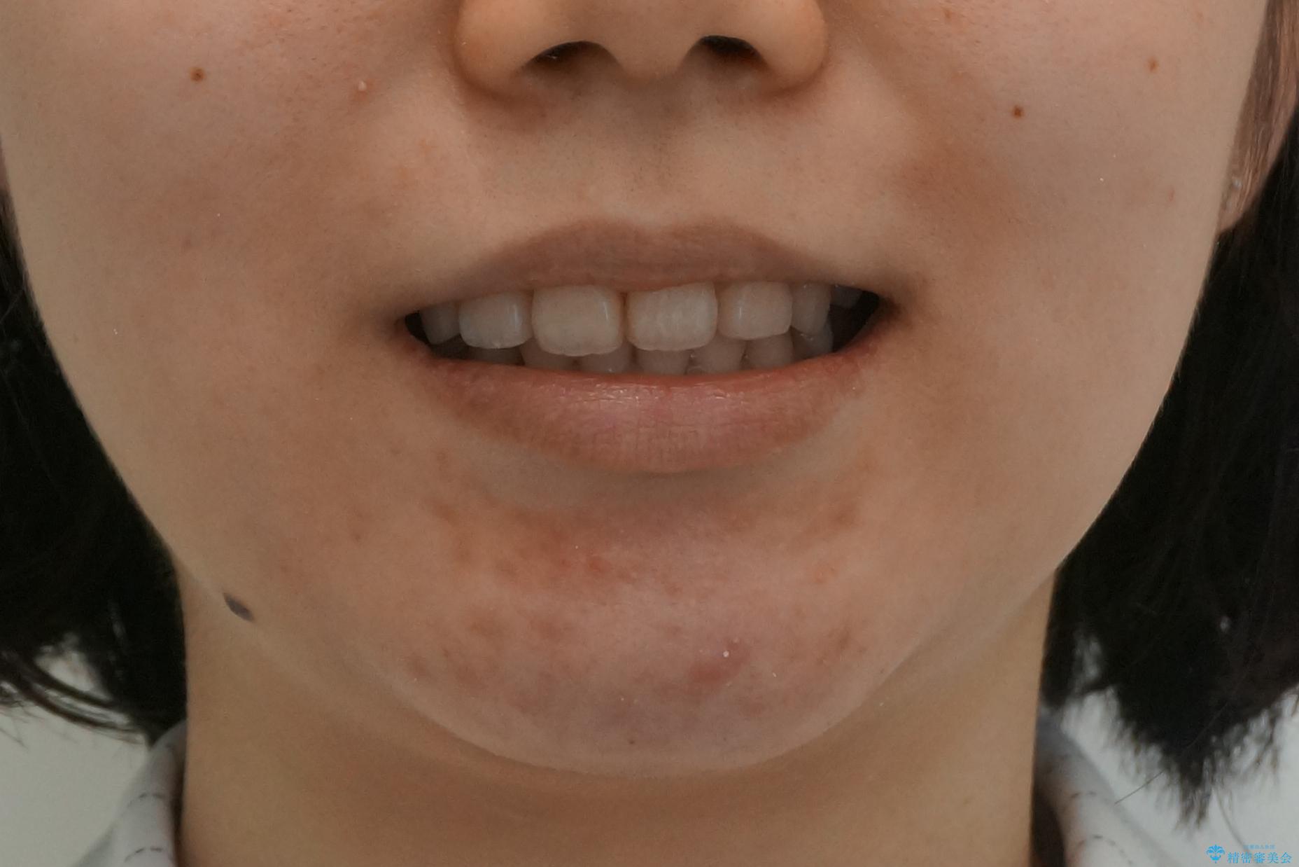 20代女性　出っ歯　口元を引っ込めたいの治療後（顔貌）