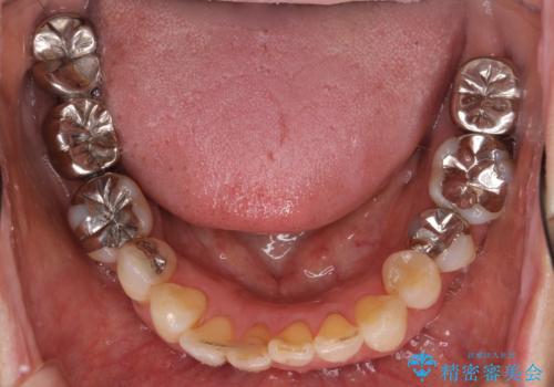 奥歯がないまま過ごしていたら前歯もぐらぐらしてきた　60代女性の治療前