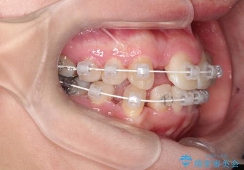 犬歯が変な位置にある　抜歯矯正により正しい位置への治療中