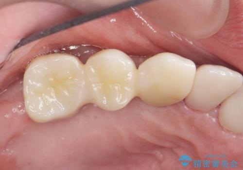 歯がぐらぐら　上顎洞底挙上術を併用した奥歯のインプラント　50代男性の治療後