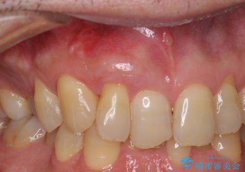 歯根が露出している歯の歯肉移植　根面被覆術の症例 治療後