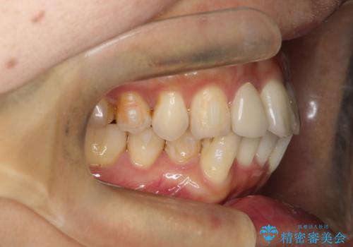 歯並びを含めて前歯をきれいにしたい　インビザラインとセラミック治療の治療中