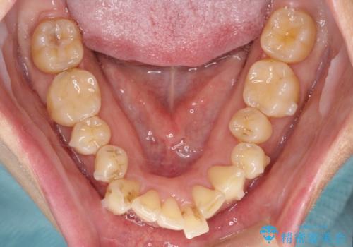 歯並びを含めて前歯をきれいにしたい　インビザラインとセラミック治療の治療中