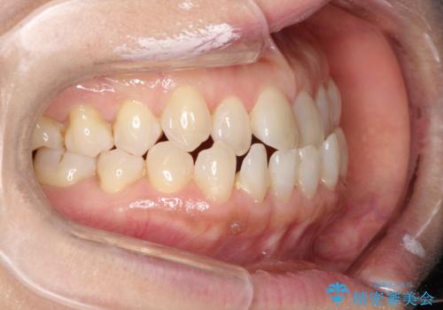 前歯の隙間　インビザラインによる目立たない成人矯正の治療前