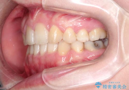 犬歯が変な位置にある　抜歯矯正により正しい位置への治療後
