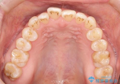 前歯の隙間　インビザラインによる目立たない成人矯正の治療前